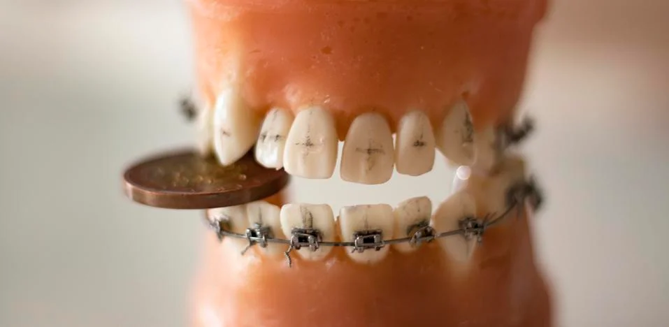 Set of denture practice teeth with braces and a coin photographed up close Stock Photos