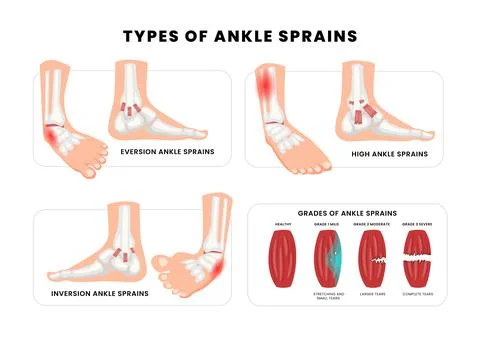 Set of different types of ankle sprains banner, foot medical injury levels .. Stock Illustration