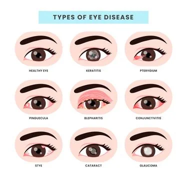 Set of different types of eye disease collection, Ophthalmology health illu.. Stock Illustration