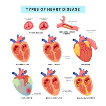 Set different Types of heart disease collection, vector illustration diagra.. Stock Illustration