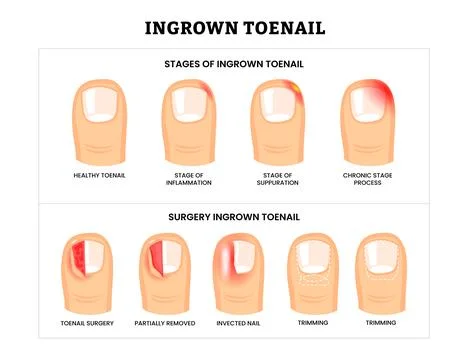 Set different types of ingrown toenail collection with ingrown toenail stag.. Stock Illustration