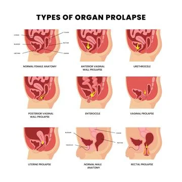 Set different types of organ prolapse diagram scheme infographic poster, ut.. Stock Illustration