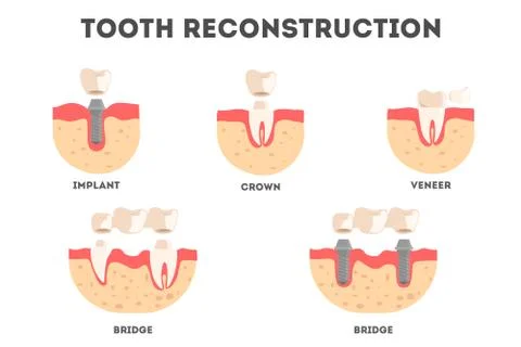 Set of diffrent human teeth reconstruction kind. Tooth loss and repacement. Stockillustratie