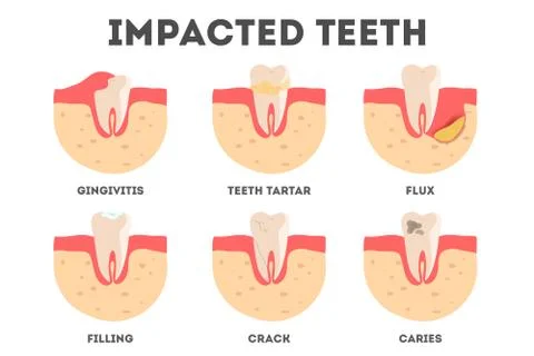 Set of diffrent impacts on human teeth. Dental and oral diseases. イラスト素材