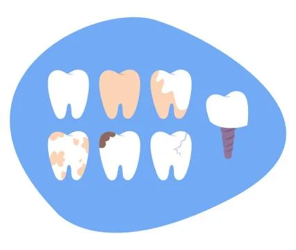 Set of diffrent impacts on human teeth. Dental and oral diseases. Illustrazione stock