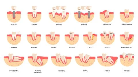 Set of human teeth in diffrent condition. Dental health and disease concept. Stockillustratie