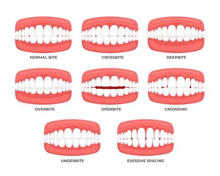 Set of Malocclusion types set with side view of normal, misalignment and in.. Stock Illustration