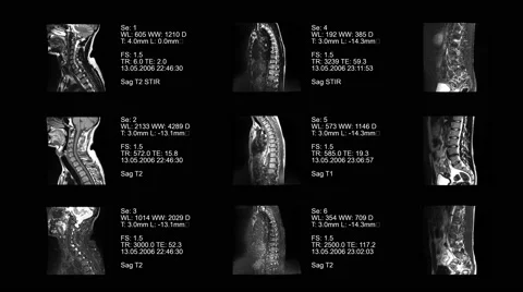 Set of spine MRI, a real animated tomography of the spine, Magnetic resonance Stock Footage 63229973