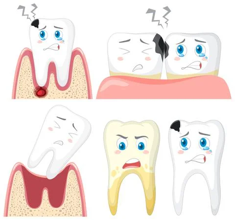 Set of teeth decay on white background Stock Illustration