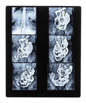 Set of X-ray with Barium studies of small bowel Foto stock