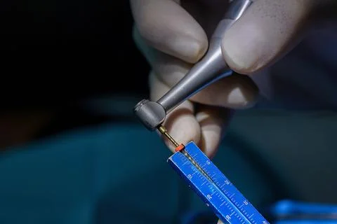 Setting endodontic file length with endo ruler before root canal treatment 库存照片