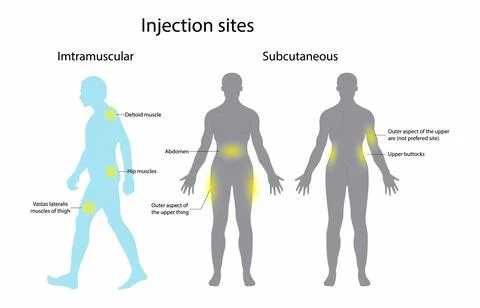 Several different sites can support an insulin injection Stock Illustration