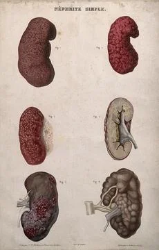 Several examples of diseased kidneys, numbered for key. Colour etching by A.. Stock Illustration