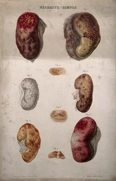 Several examples of diseased kidneys, numbered for key. Colour etching by A.. Stock Illustration