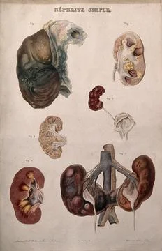 Several examples of diseased kidneys, numbered for key. Colour etching by A.. Stock Illustration
