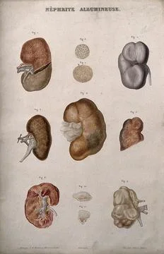Several examples of diseased kidneys, numbered for key. Colour etching by A.. Stock Illustration