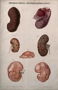 Several examples of diseased kidneys, numbered for key. Colour etching by A.. Stock Illustration
