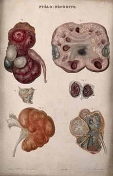 Several examples of diseased kidneys, numbered for key. Colour etching by O.. Stock Illustration