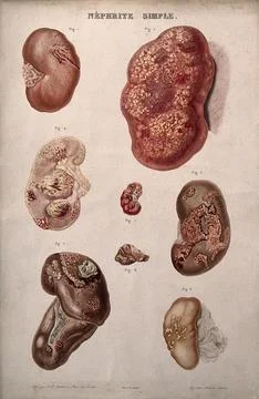 Several examples of diseased kidneys, numbered for key. Colour etching by A.. Stock Illustration