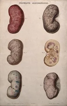 Several examples of diseased kidneys, numbered for key. Colour etching by A.. Stock Illustration