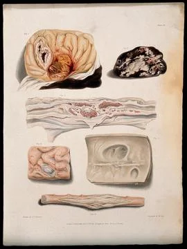 Several sections of diseased brain and spine. Coloured stipple etching by W.. Stock Illustration