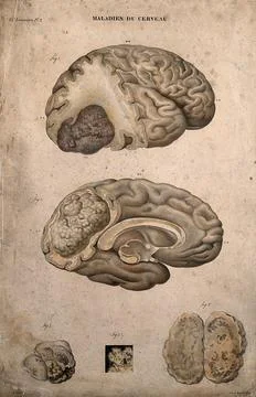 Several sections of diseased brain, numbered for key. Coloured lithograph b.. Stock Illustration