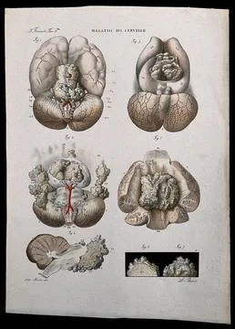 Several sections of diseased brain, numbered for key. Coloured lithograph b.. Stock Illustration