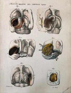 Several sections of diseased brain, numbered for key. Coloured lithograph b.. Stock Illustration