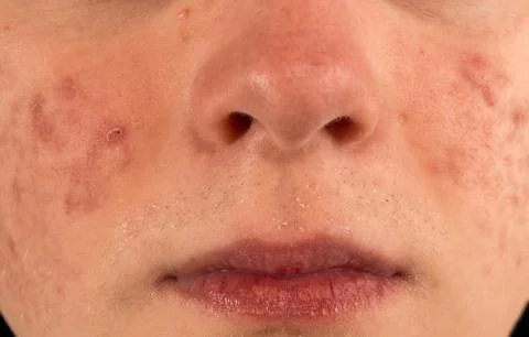 Severe Acne Foto stock