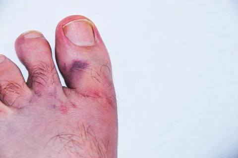 Severe contusion of a caucasian male foot from a work accident Stock Photos