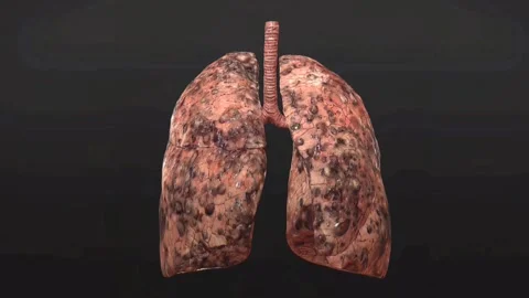 Severe COPD lungs Stock Footage 294378414