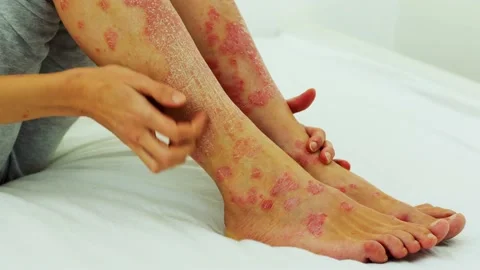 Severe exacerbation of psoriasis. Itching and pain, scratching of wounds. Stock-Footage 238764001