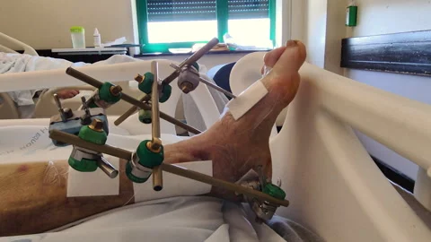 Severe foot deformities on an elderly patient’s foot in a hospital bed Video stock 333187180