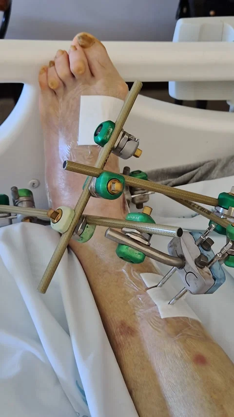 Severe foot deformities on an elderly patient’s foot in a hospital bed Video stock 333190420