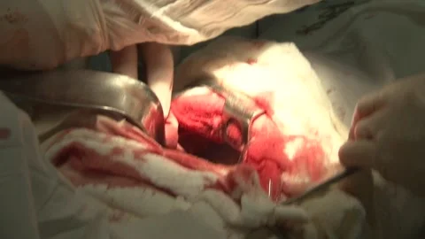 Severe operation on the patient Stock Footage 130793964