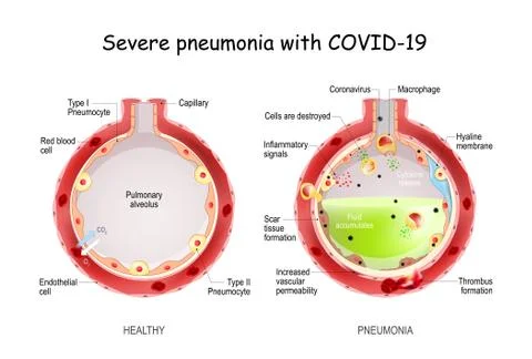 Severe pneumonia with COVID-19. Stock Illustration