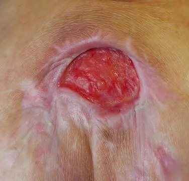 Severe Pressure Ulcer on the Lower Back, Close-Up Medical Image Foto stock