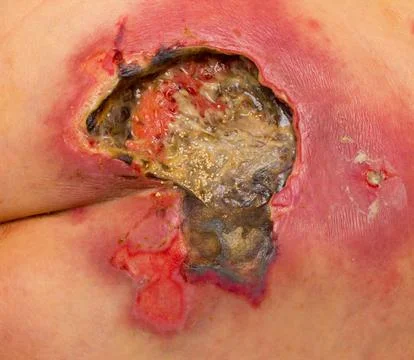 Severe Pressure Ulcer on Lower Back with Necrotic Tissue Foto stock