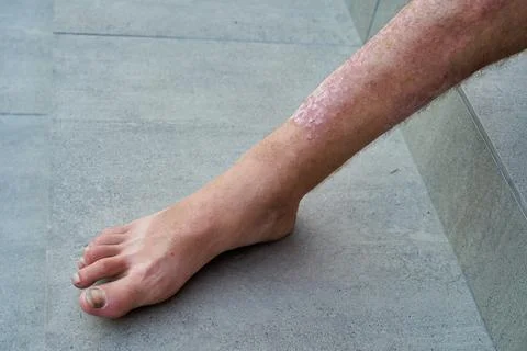 Severe psoriasis on a man's leg close-up. Stock Photos