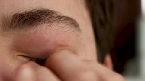 Severe scratching of the red eyelid by allergic patient close-up Stock Footage 320329545