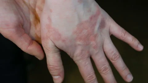 Severe skin dermatitis on the outside of the hand. Average shot, real time, cont Stock Footage 128996949
