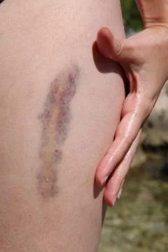Severe thigh bruise on a young woman's leg. Medical image - contusion, hemato Stock Photos