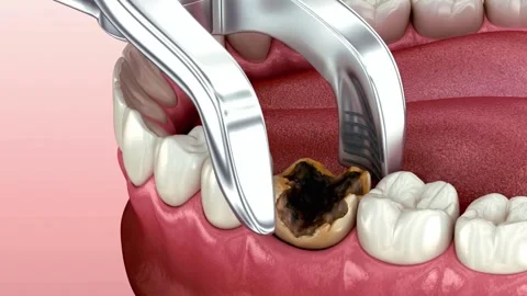 Severely Decayed Tooth Being Extracted by Forceps Stock Footage 327665500