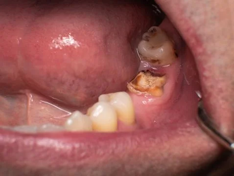 Severely destroyed lower second molar reduced almost to the gum Stock Photos