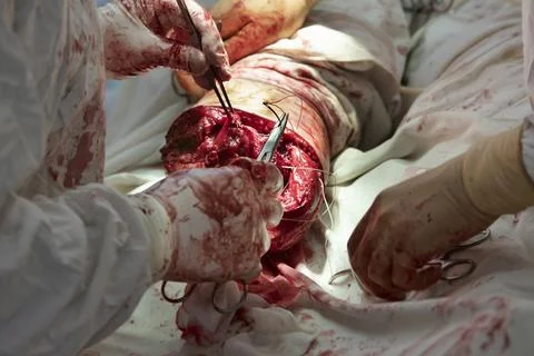 Sew Tissues During Amputation Фото
