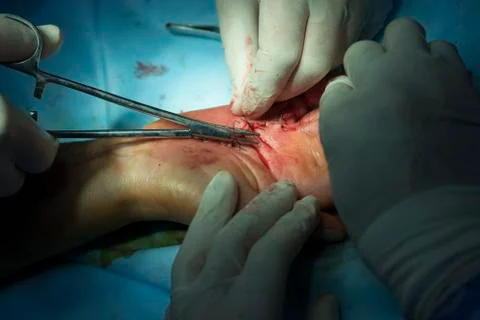 Sewing up the hand Stockfoto's