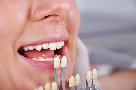 Shade determination tooth Foto stock