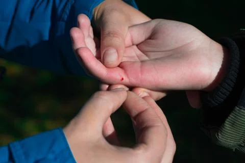 Sharp bee sting with a bag of poison broke the skin and left it Stock Photos