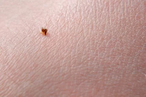 Sharp bee sting with a bag of poison broke the skin and left it. Apitherapy Stock Photos