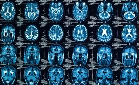 Sharp Texture of a human brain in ct Stock Photos